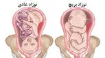 علت بریچ بودن جنین چیست؟