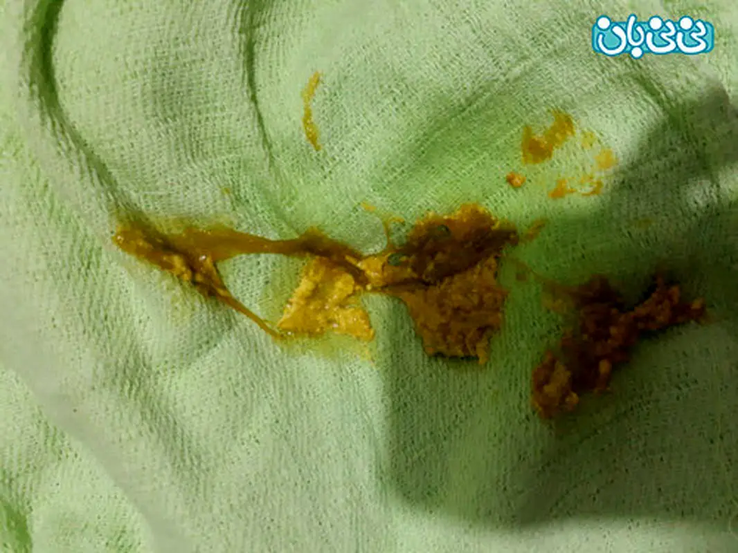مدفوع لزج نوزاد، ممکنه عفونت باشه؟