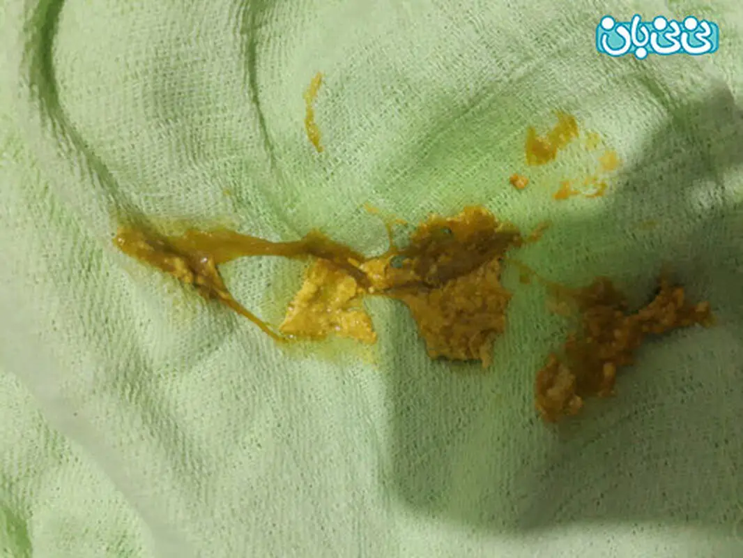 مدفوع لزج نوزاد، ممکنه عفونت باشه؟