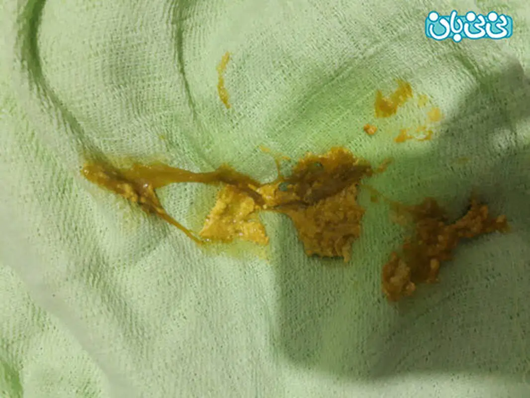 مدفوع لزج نوزاد، ممکنه عفونت باشه؟