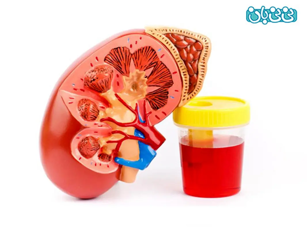 وجود خون در ادرار، مشکل جدی در زنان