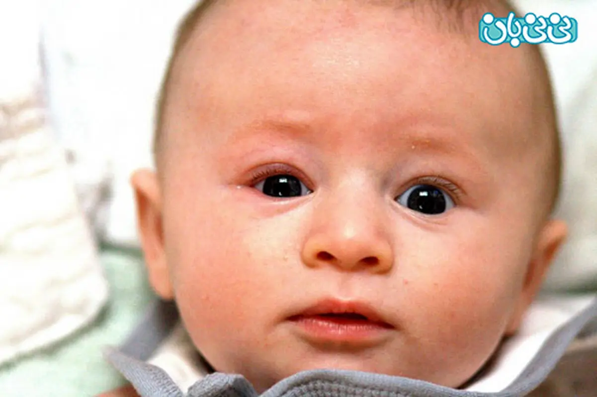 قی کردن چشم نوزاد، چه درمانی دارد؟