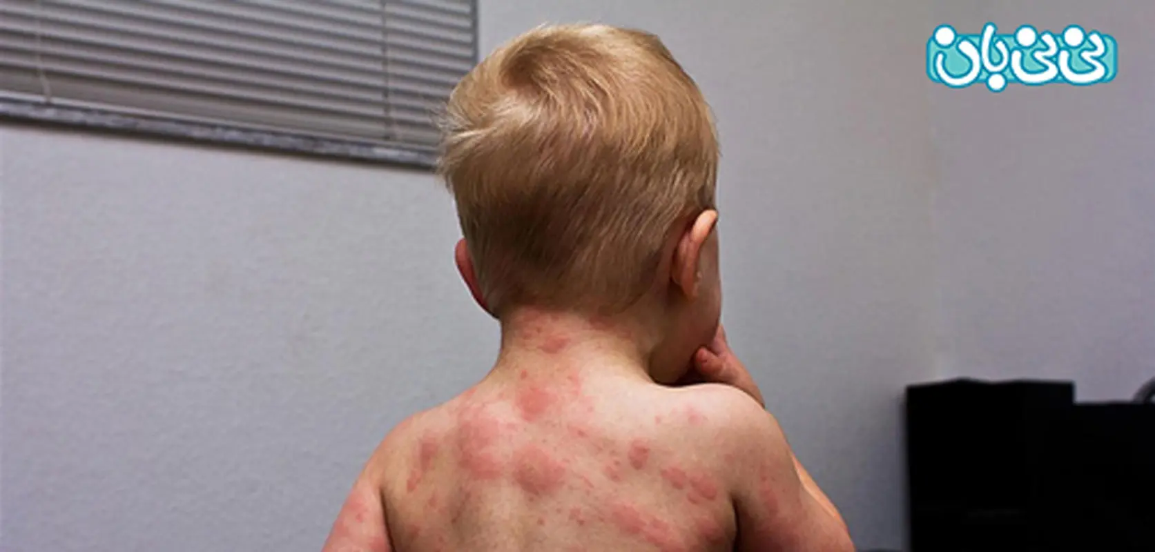 بیماری روزئولا در کودکان، چیست و چه علائمی دارد؟