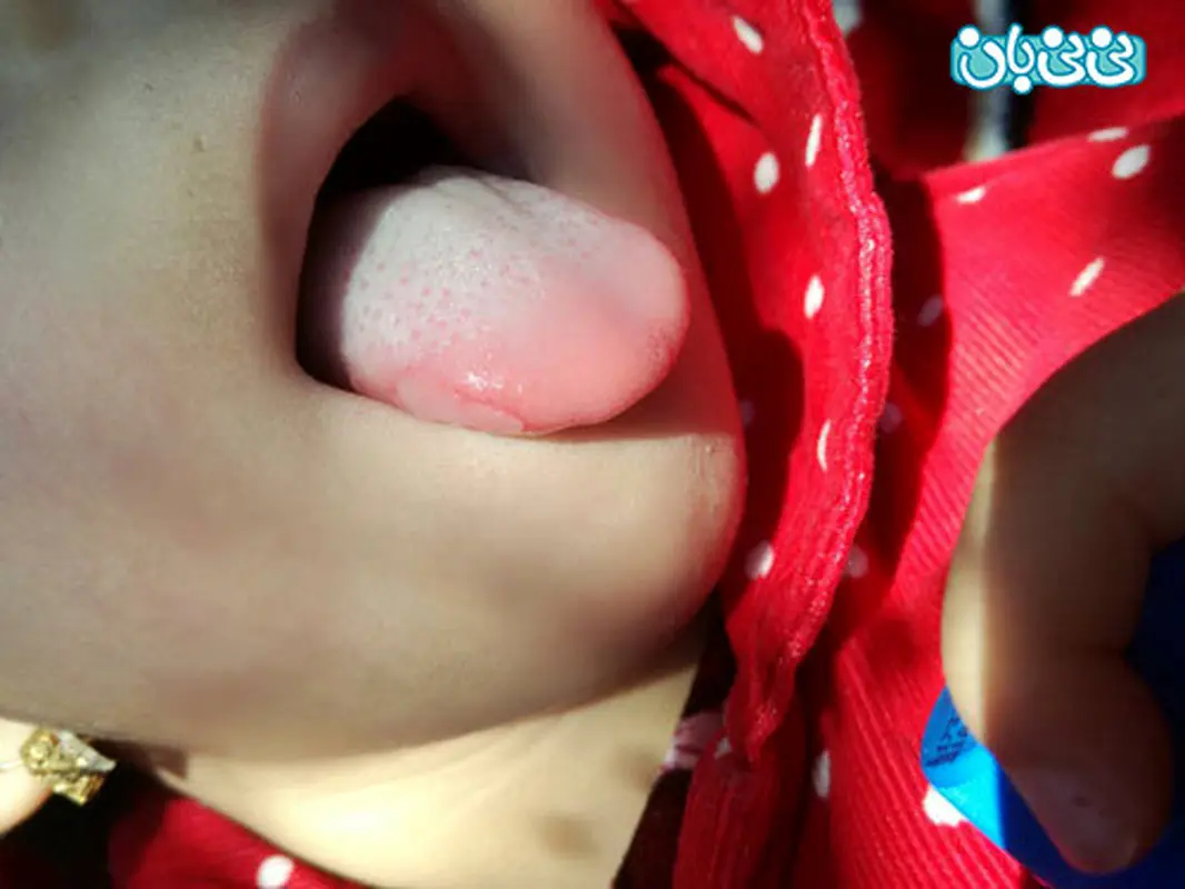 برفک دهان کودک، چگونه درمان می‌شود؟