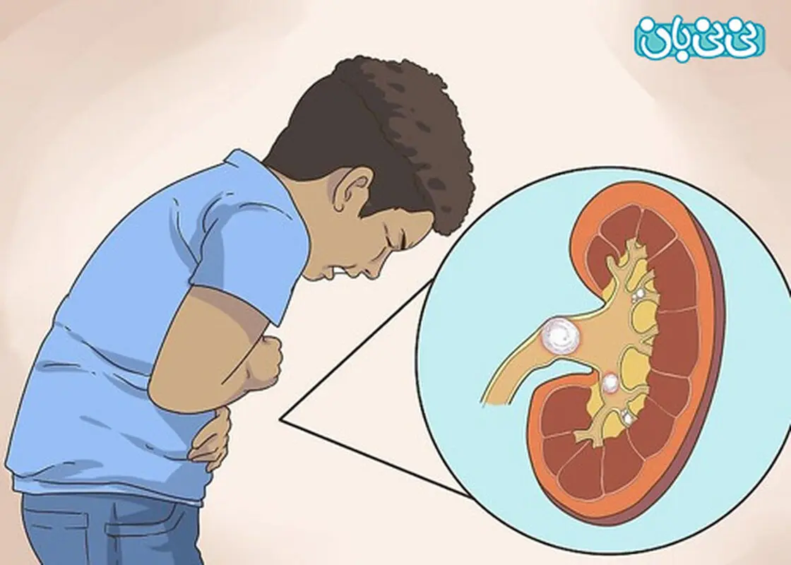 علائم سنگ کلیه کودکان، چند نکته
