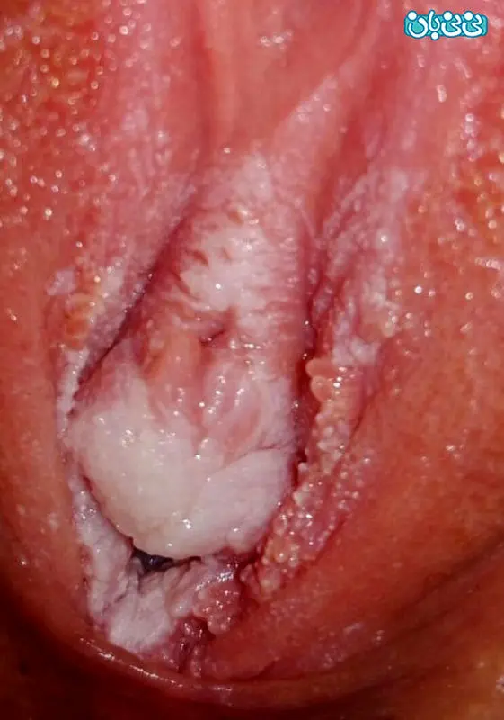 سفید شدن دهانه واژن، زگیله؟