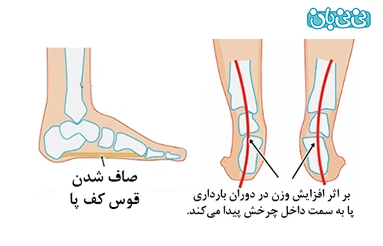 پا درد در دوران بارداری، چه عللی دارد؟