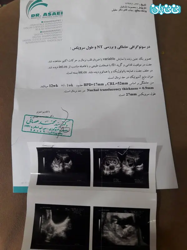 کوتاهی طول سرویکس، نیازمند سرکلاژه؟