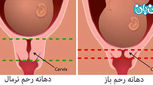 طول سرویکس در بارداری، چقدر باشد طبیعیست؟