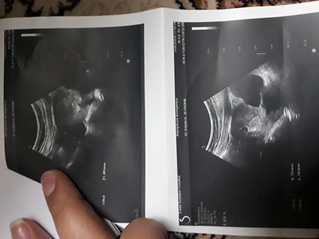 ساک حاملگی بدون جنین، ناشی از چیه؟