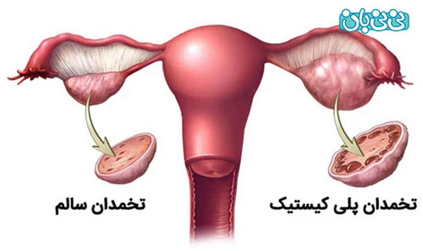 کیست تخمدان بترکد چه میشود؟