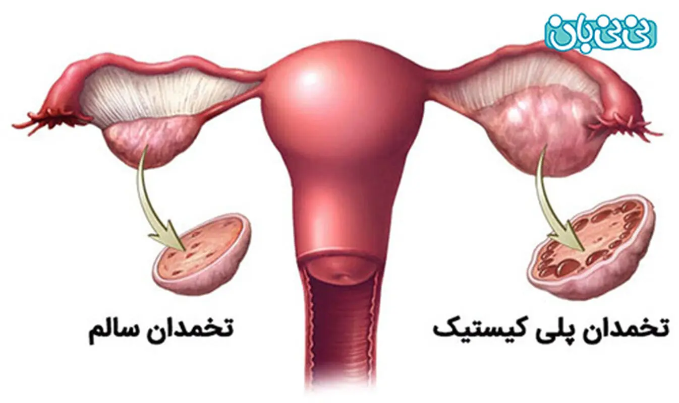 کیست تخمدان بترکد چه میشود؟