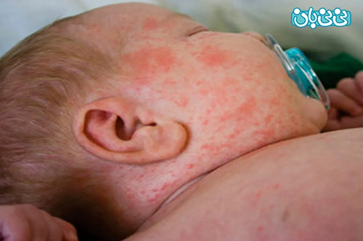علائم سرخک در کودکان، راه‌های تشخیص و درمان آن