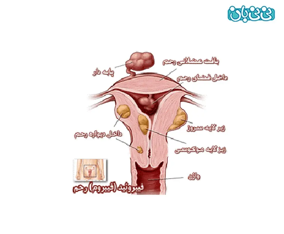 علت میوم در رحم زنان، چیست؟