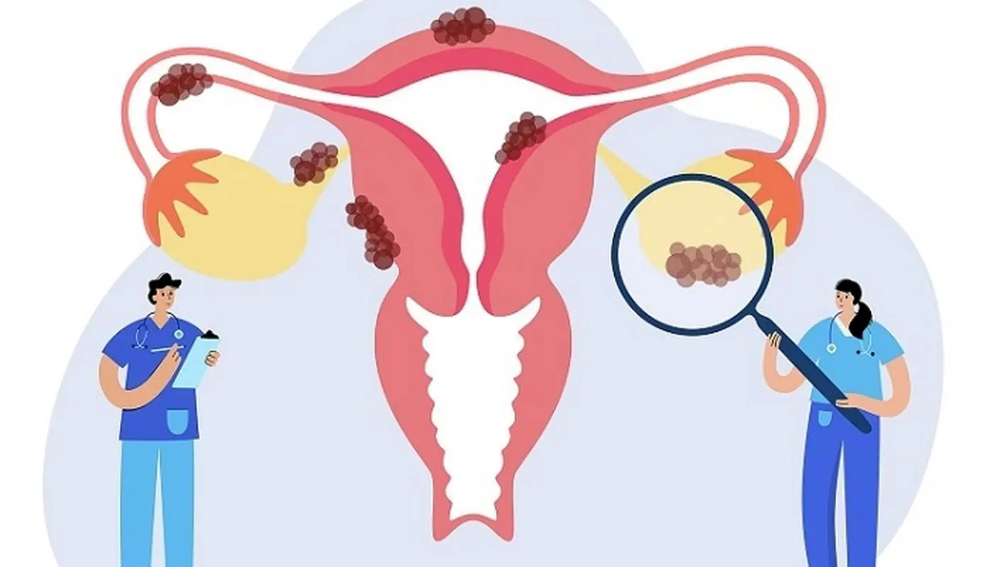 کیست شکلاتی تخمدان، علائم و درمان