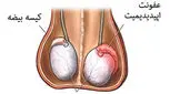 علت درد بیضه سمت راست چیست؟