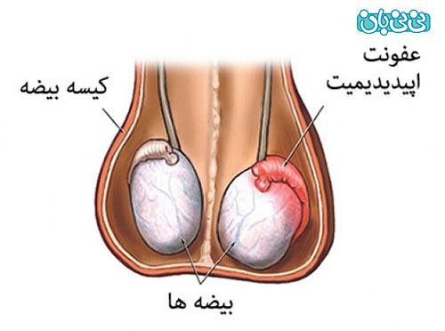 تورم بالای بیضه سمت چپ+تورم بالای بیضه سمت راست