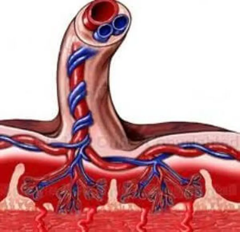 مشکلات بند ناف تک شریانی، چیست؟