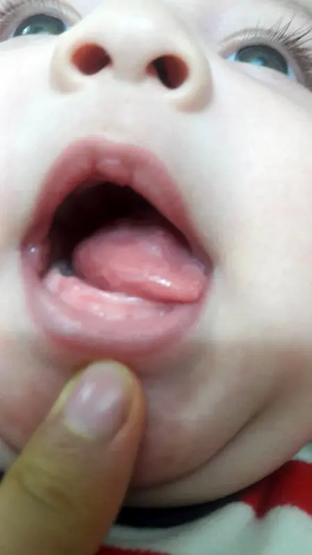 لکه زبان نوزاد، ناشی از چیه؟