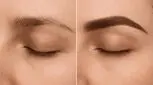 فیبروز ابرو چیست؟ هزینه‌، مزایا و معایب آن