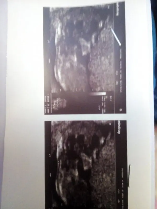 عدد nt در بارداری، آیا نرمال است؟