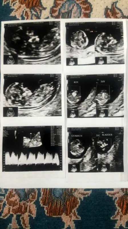 تفسیر آزمایش غربالگری، نتیجه خوب است؟