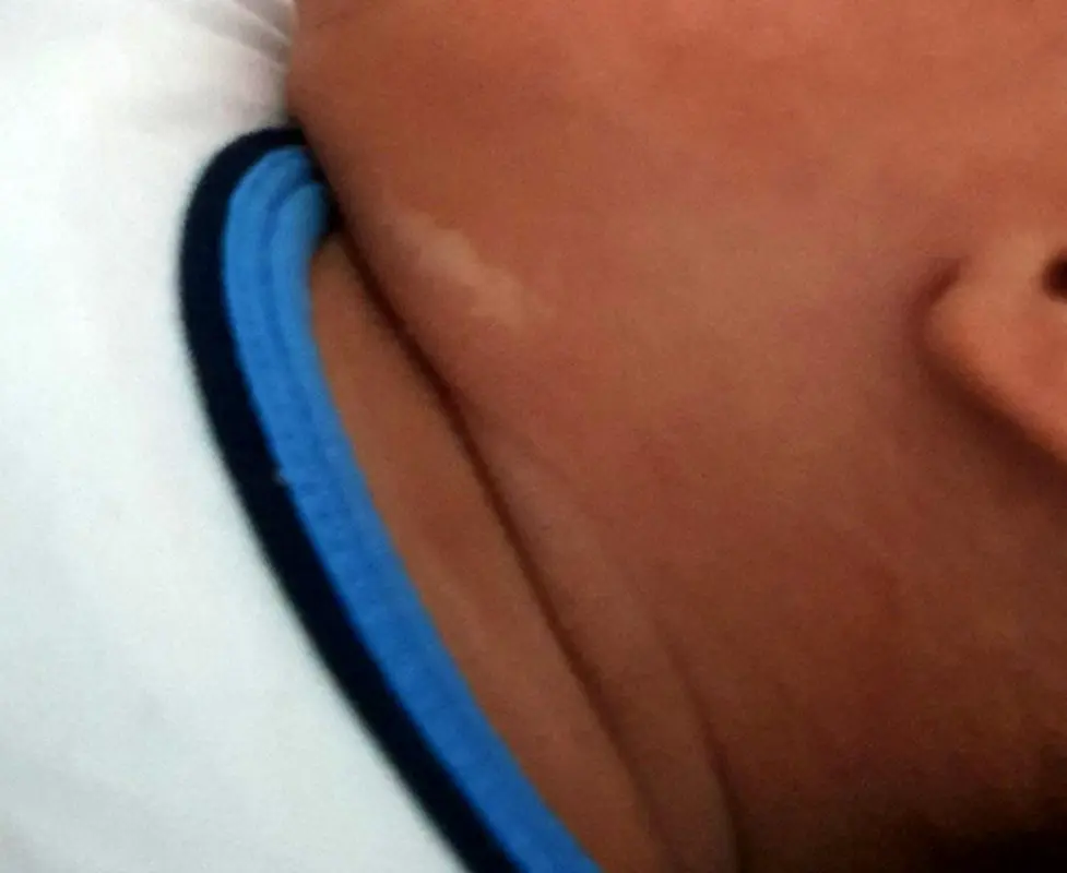 بیماری پوست نوزادان، این لک پیسی است؟