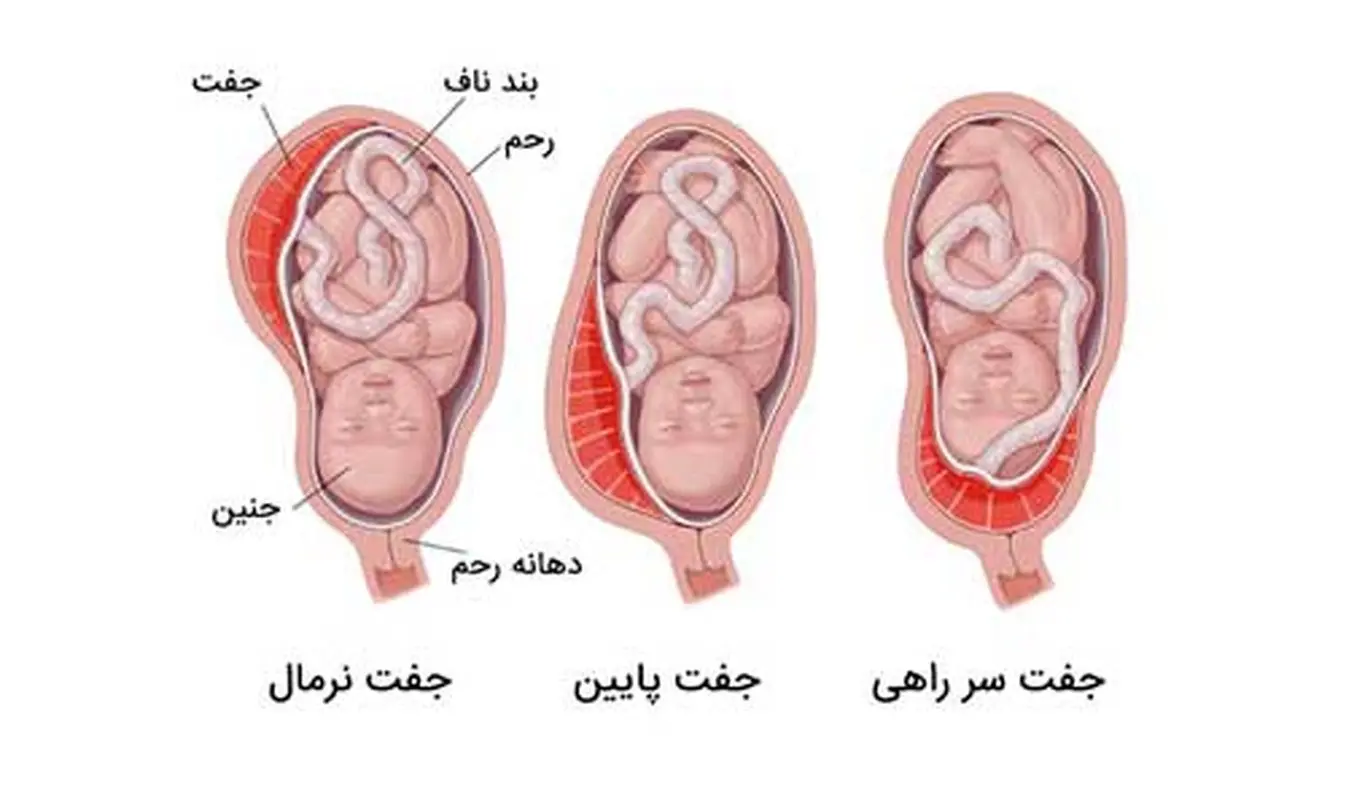 چگونگی تشخیص جفت سرراهی