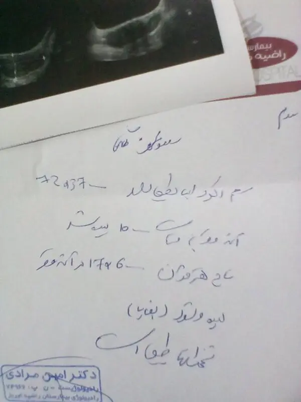 ال دی بعد از سقط، باعث دفع بقایا میشود؟