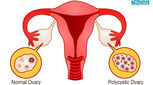 چطور تنبلی تخمدان را درمان کنیم؟