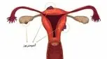 اندومتریوز چیست و چه علائمی دارد؟
