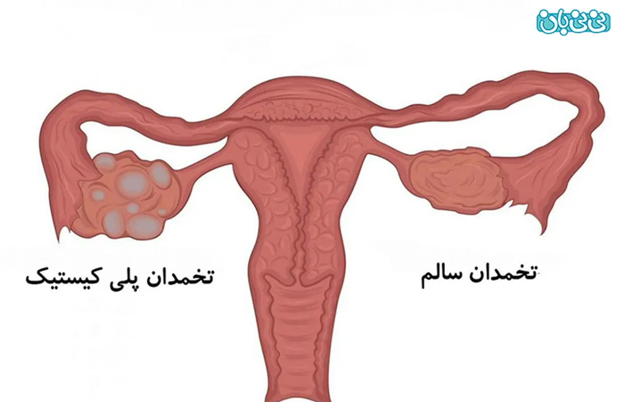علائم سندرم تخمدان پلی کیستیک چیست؟