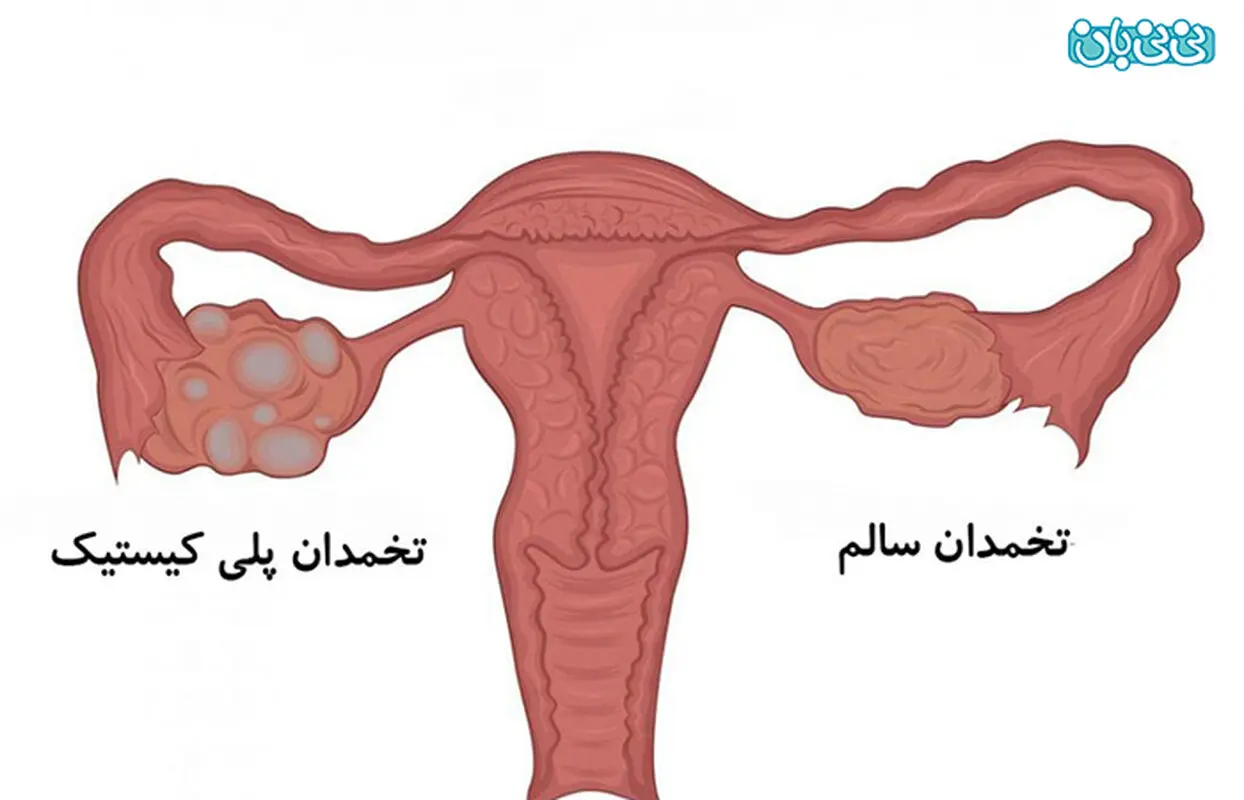 علائم سندرم تخمدان پلی کیستیک چیست؟