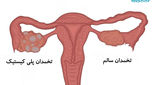 علائم سندرم تخمدان پلی کیستیک چیست؟