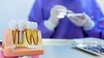 ایمپلنت فوری دندان چیست، قیمت آن چقدر است؟