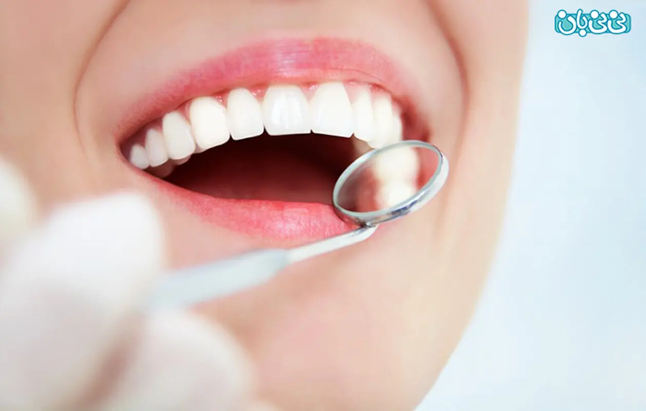 کامپوزیت ونیر یا لمینت؟ کدام روش بهتر است؟