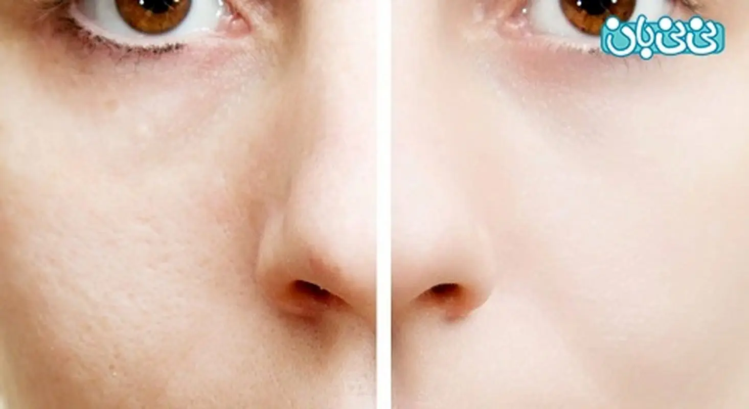 لیزر اربیوم چیست و چه مزایا و معایبی دارد؟