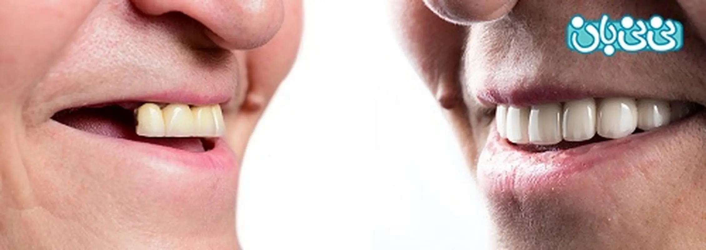 قیمت پروتز دندان مصنوعی و انواع آن