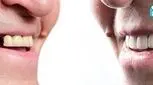 قیمت پروتز دندان مصنوعی و انواع آن