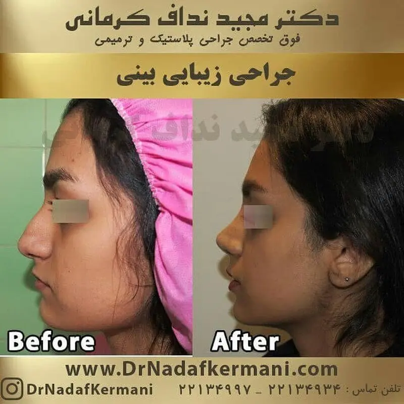 جراحی بینی استخوانی، قبل از عمل بخوانید!