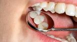  قیمت کامپوزیت دندان سال 1403 روش سفیدی دندان