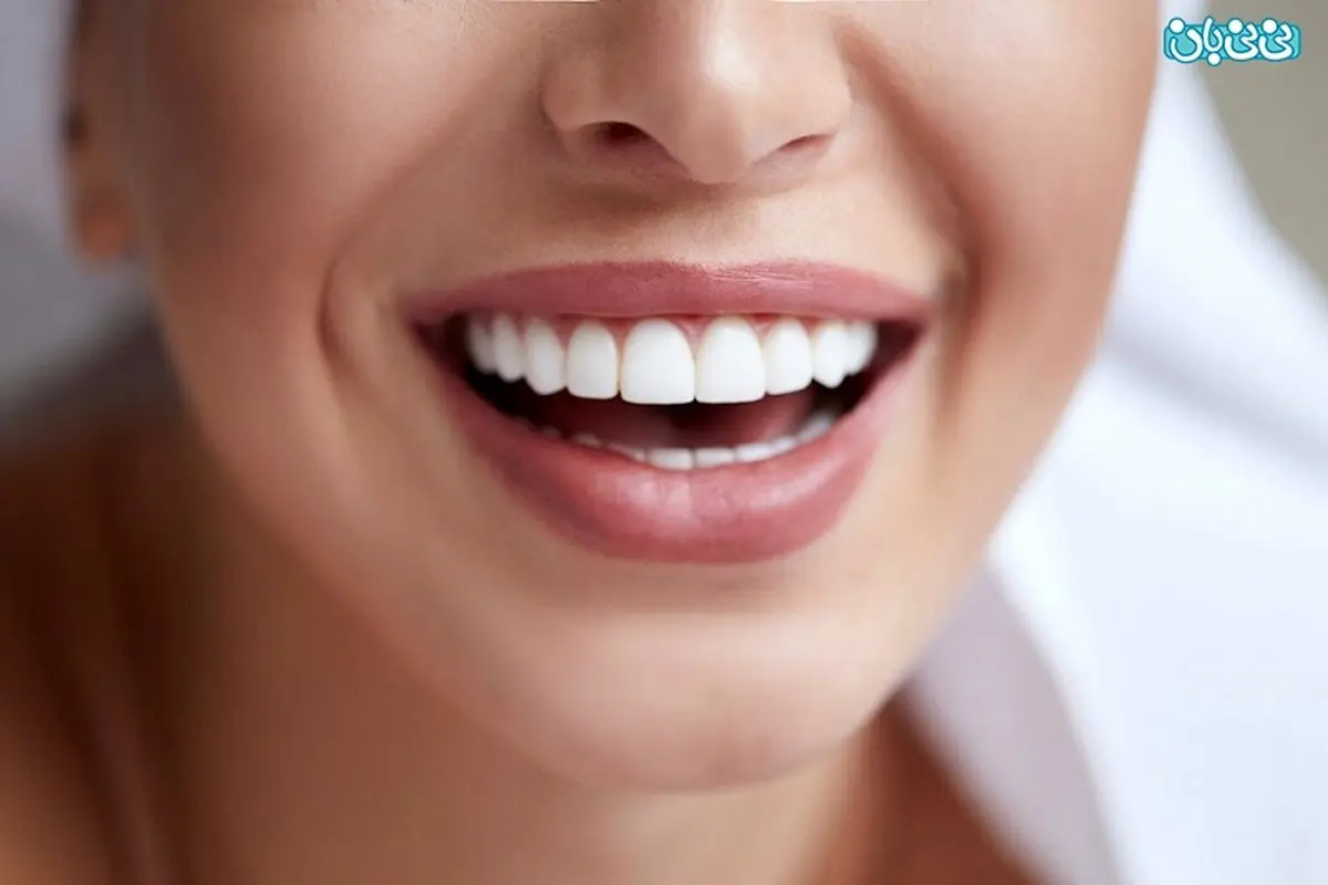 لمینت دندان بدون تراش امکانپذیر است؟