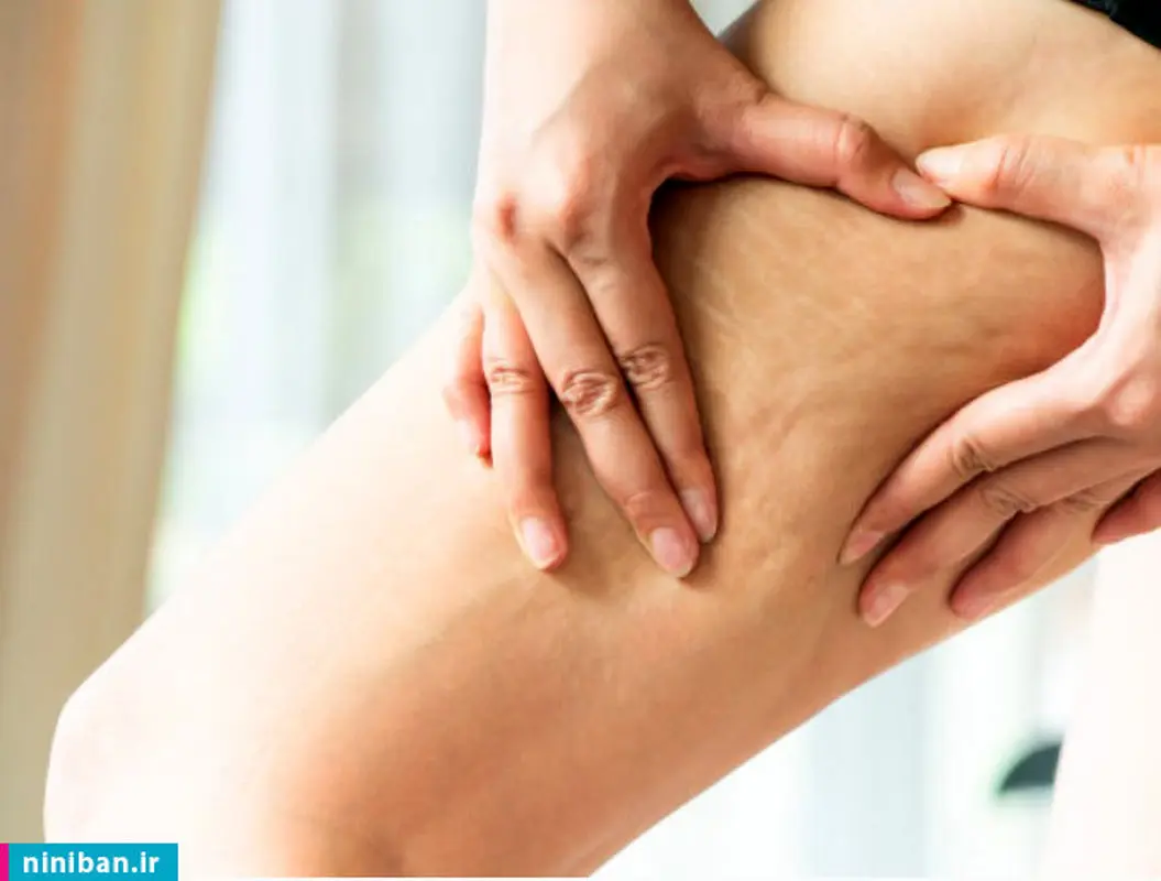 رفع سلولیت با لیزر در ران، بازو و پهلو