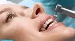 آشنایی با نکات مهم جرم‌ گیری دندان