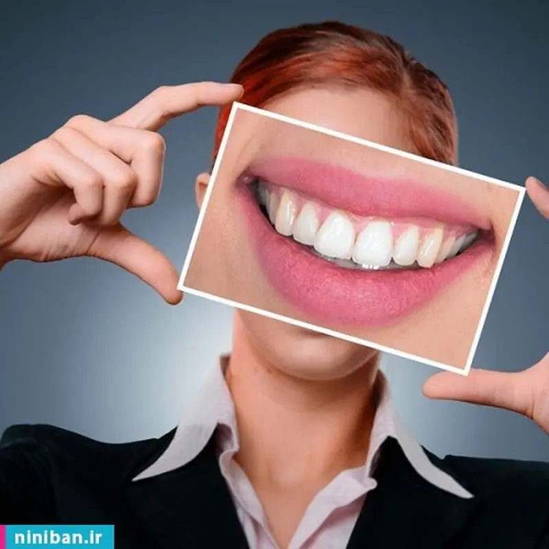 لمینت دندان و جدیدترین انواع آن