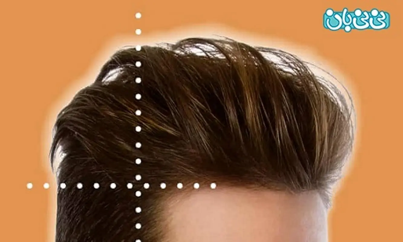 جدیدترین روش کاشت مو با رشد طبیعی مو چیست؟