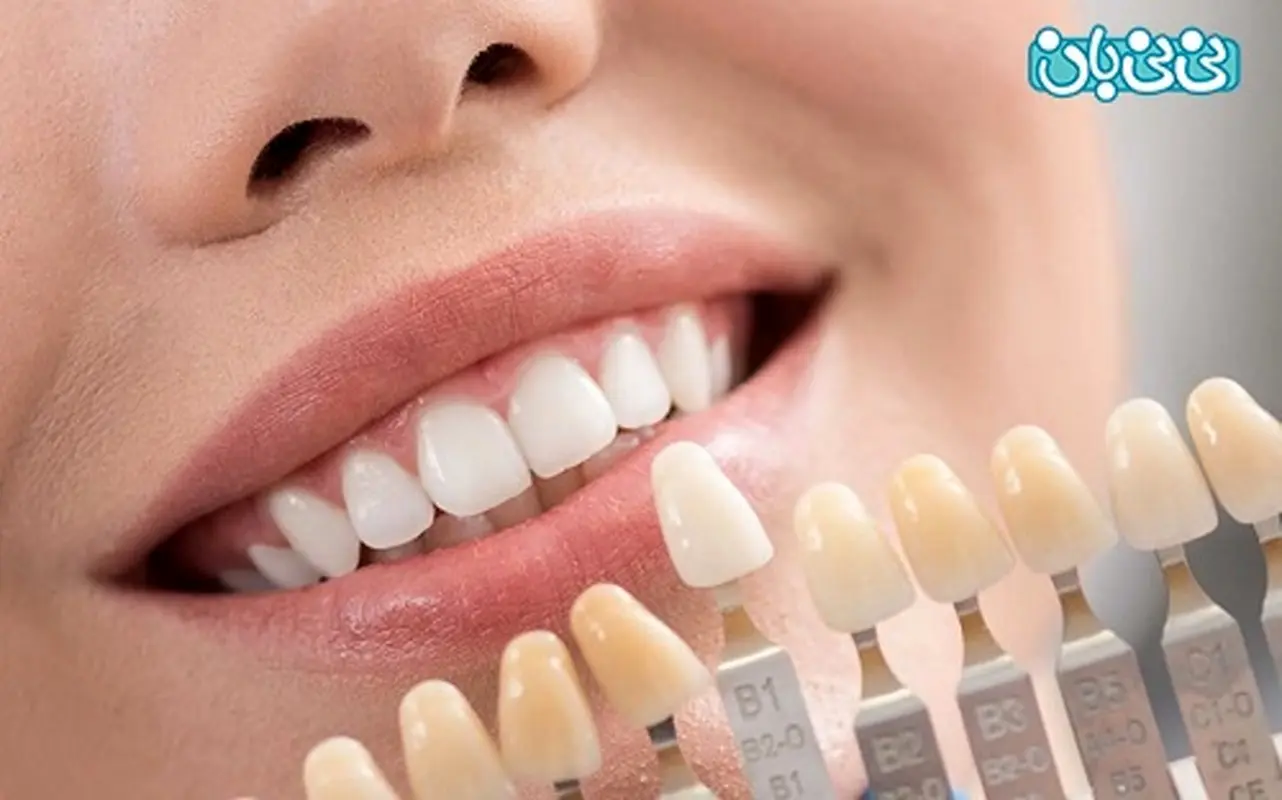 طول عمر لمینت دندان، از کامپوزیت بیشتره؟