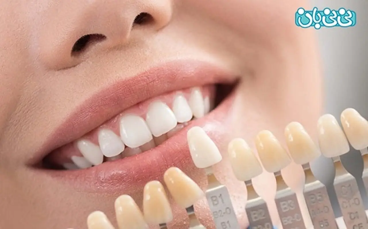 طول عمر لمینت دندان، از کامپوزیت بیشتره؟
