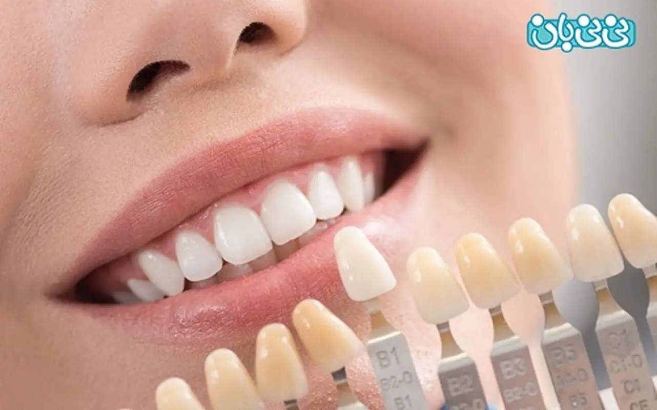 طول عمر لمینت دندان، از کامپوزیت بیشتره؟