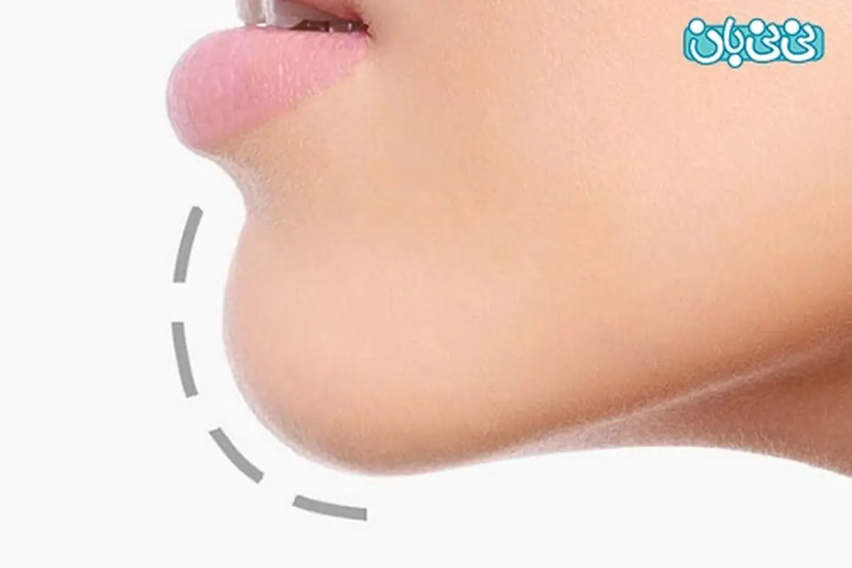 بازسازی فک پایین، چه روش‌هایی دارد؟